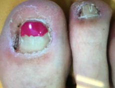 Валентина, 36 лет, время лечения – 1,5 года